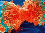 Forma më e shpeshta me të cilat shfaqet kanceri