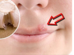 Trajtimi i puçrrave