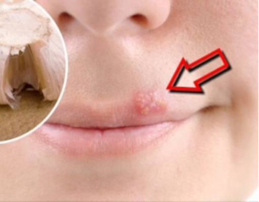 Trajtimi i puçrrave