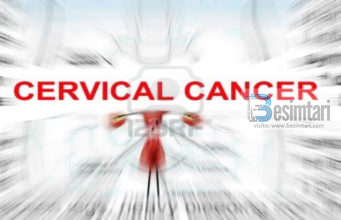 Kanceri i Qafës së Mitrës