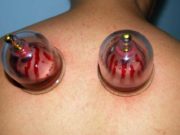 Heqja e gjakut (Hixhame)