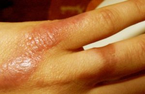 Mjekimi i djegieve me mjaltë