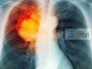 Si fillon kanceri në mushkëri dhe si të parandalohet?