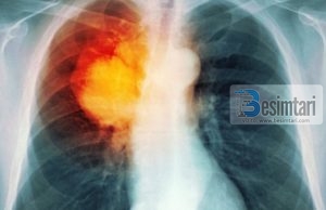 Si fillon kanceri në mushkëri dhe si të parandalohet?