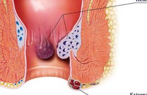 Hemorroidet, shkaqet dhe trajtimi i tyre
