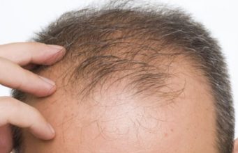 Cilët jan shkaktarë të Humbjes së flokëve (Alopesia)?