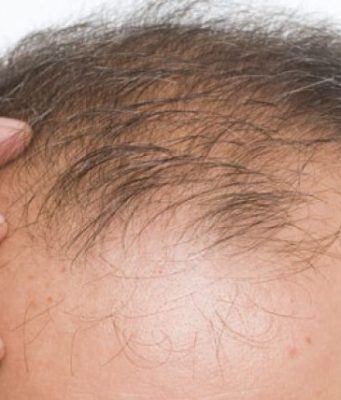 Cilët jan shkaktarë të Humbjes së flokëve (Alopesia)?