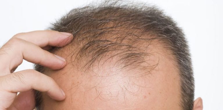 Cilët jan shkaktarë të Humbjes së flokëve (Alopesia)?