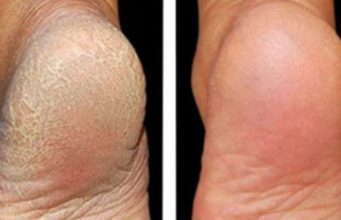 Shëroni thembrat e plasaritura vetëm me këtë përzierje