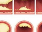 Bllokimi i arterieve, mbipesha dhe sheqeri