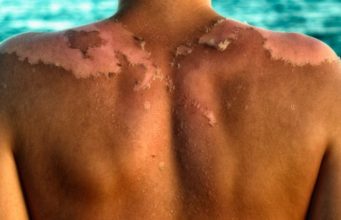 Mënyrat më të shpejta për të kuruar djegien nga dielli në shtëpi