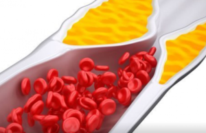 KËSHILLA PËR TË ULUR KOLESTEROLIN