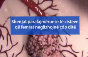 Shenjat paralajmëruese të cisteve që femrat neglizhojnë çdo ditë