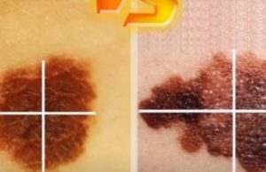 Nishan apo kancer? Kjo video ju informon shumë