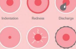 7 PREVENTIVAT NATYRALE NDAJ KANCERIT TE GJIRIT