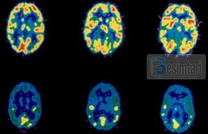 LËNDËT NARKOTIKE BËJNË QË TRURI TA HAJË VETVETEN