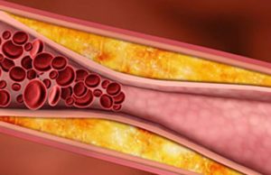 Kur është i rrezikshëm Kolesteroli?