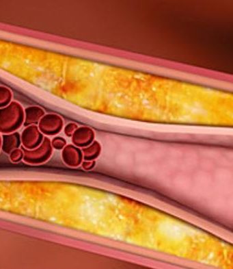 Kur është i rrezikshëm Kolesteroli?