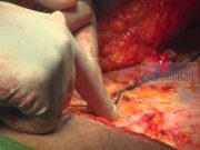 A lejohet heqja e dhjamit me operacion kirurgjik?