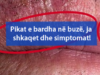 Pikat e bardha në buzë, ja shkaqet dhe simptomat!