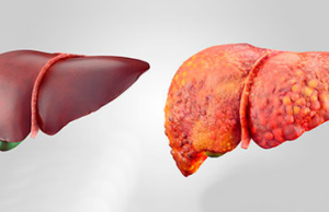 Pastrimi i mëlçisë dhe parandalimin e sëmundjeve të saj