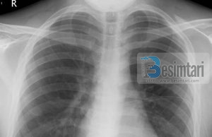 SËMUNDJE TË GJOKSIT