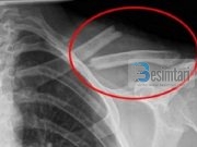 Kjo pije helmuese është vrasësi i kockave tuaja dhe ju e pini atë çdo ditë