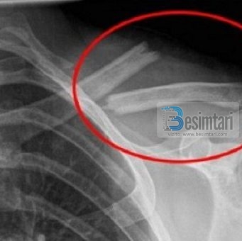 Kjo pije helmuese është vrasësi i kockave tuaja dhe ju e pini atë çdo ditë