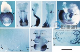 Abortimi i fetusit të deformuar
