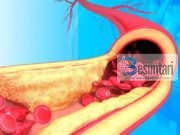 Receta për shërimin e arterieve të bllokuara dhe kolesterolin e tepërt