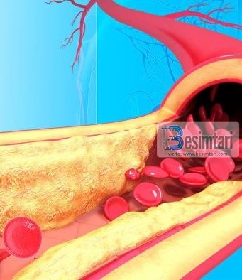 Receta për shërimin e arterieve të bllokuara dhe kolesterolin e tepërt