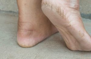 Si t’i shëroni në shtëpi thembrat e plasaritura