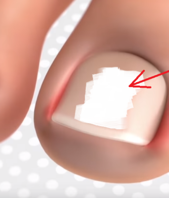 Nëse keni problem me gishtin e madh të këmbes!