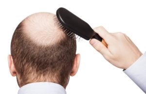 Sëmundjet që fshihen pas rënies së flokëve