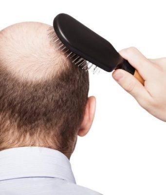 Sëmundjet që fshihen pas rënies së flokëve