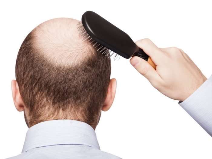 Sëmundjet që fshihen pas rënies së flokëve