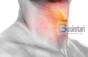 Dhimbja në fyt , shkaktarët dhe mjekimi i saj
