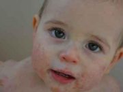 Këto ushqime shkaktojnë alergji te fëmijët e vegjël, kujdesi që duhet të tregoni