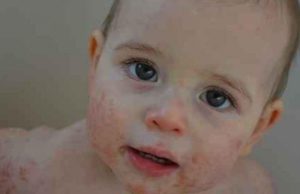 Këto ushqime shkaktojnë alergji te fëmijët e vegjël, kujdesi që duhet të tregoni