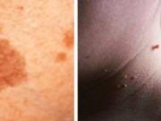 7 menyra si te zgjidhim natyrshëm problemet e shumta te lekures si lythat, pikat e zeza dhe njollat e moshes!