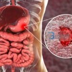1800ss_science_source_rf_stomach_ulcer-640×426